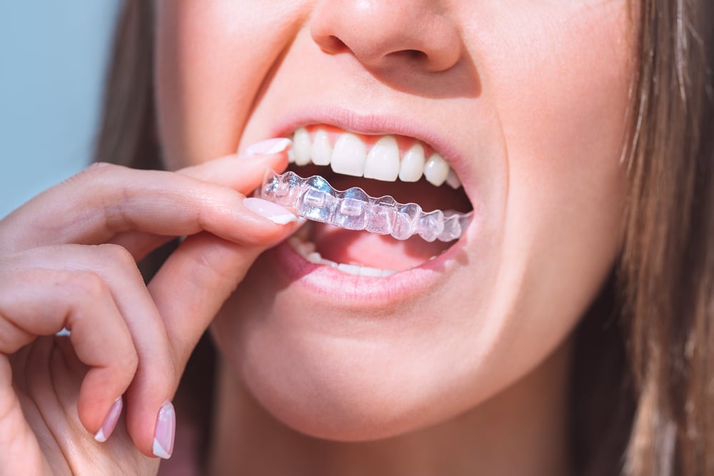 A girl with invisalign